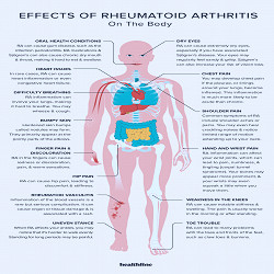 Effects of Rheumatoid Arthritis: Skeletal System, Immune, More